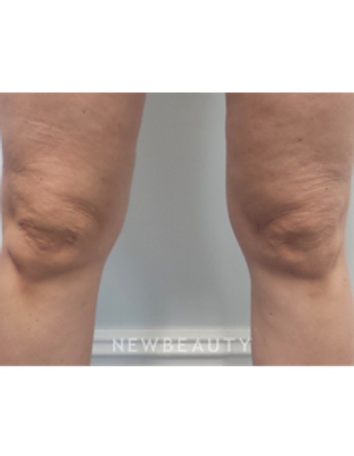 Dr. Marina Peredo - Ulthera - After