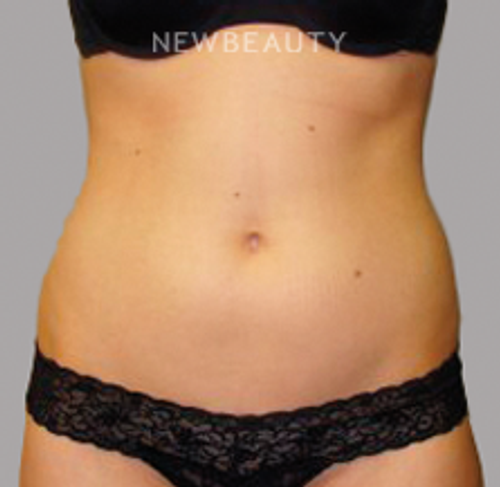 Dr. Sanjay Grover - Liposuction - 49728022 - Before