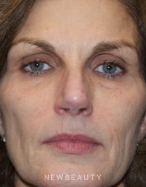 Dr. Marina Peredo - Sculptra - After