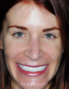 Dr Guy Lewis Crowns, Dental Implants, Gum Contouring - After