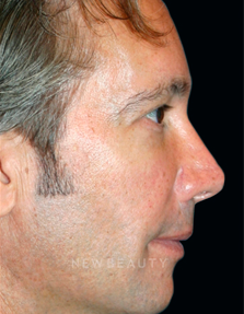 Dr. Kelly Bomer Injectables - After