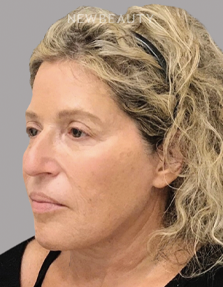 Dr. Janet Allenby - “Liquid Facelift” - After