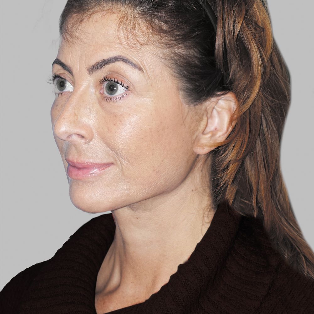 after deep-plane facelift and necklift, combined with Fraxel and Morpheus8