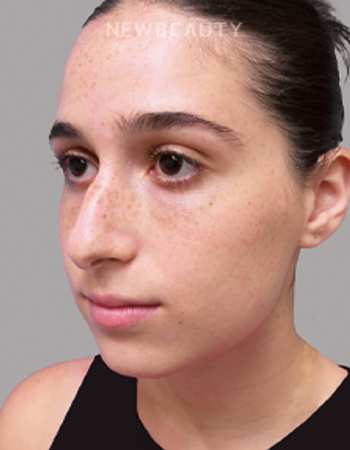 Dr. Michael A. Epstein - Natural-Looking Results - 33109401 - Before