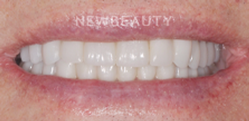Dr. Salvator La Mastra - Smile Makeover -46107962 - After