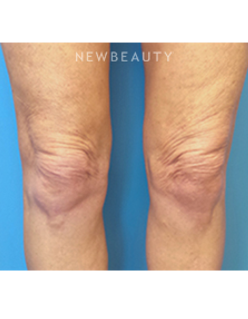 Dr. Christine Hamori - Thermage - After