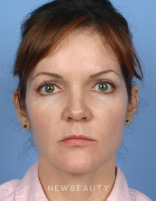 Dr. Kelly Bomer-Liquid Facelift - After