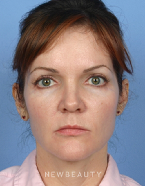 Dr. Kelly Bomer-Liquid Facelift - After