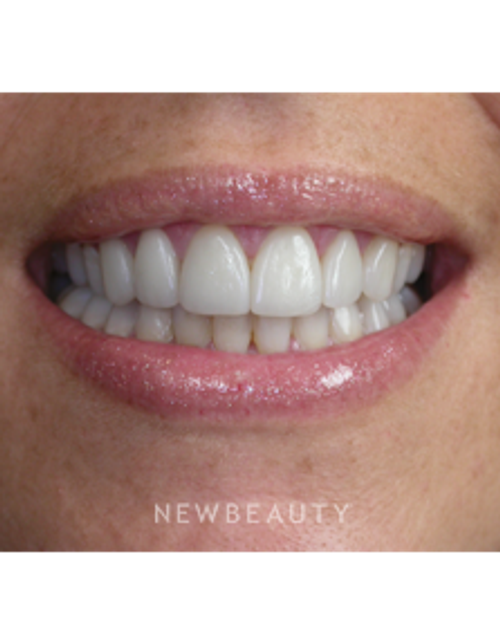 Dr. Irene Grafman - Smile Makeover - After