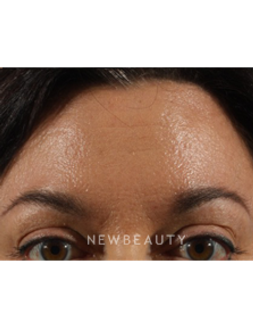 Dr. Marina Peredo - Botox - After