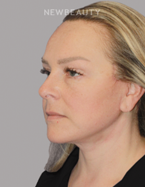 Dr. Konstantin Vasyukevich – Deep Plane Face and Neck Lift – 46903849 - After