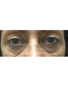 Dr. Roman Rayham - Blepharoplasties - Before