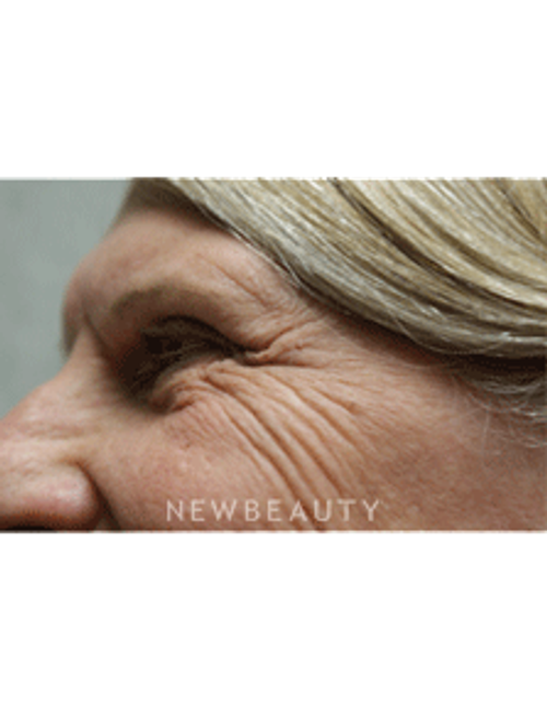 Dr. Marina Peredo Elos Injections/Liquid Lift - Before