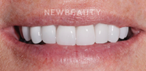 Dr. Salvator La Mastra - Smile Makeover - 46106865 - After