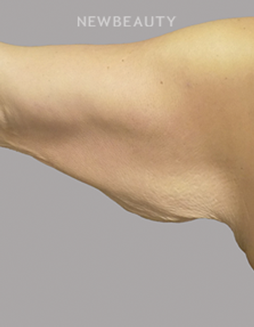 Dr. Jeffrey R. Antimarino - Arm Lift - 25108480 - Before