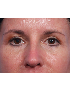 Dr. Kelly Bomer - Facelift - After