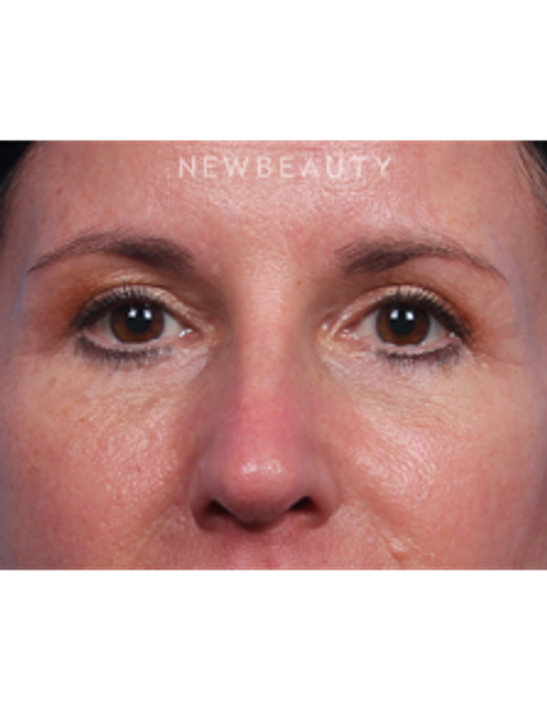 Dr. Kelly Bomer - Facelift - After