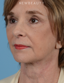 Dr. Henry Mentz - Facelift - After