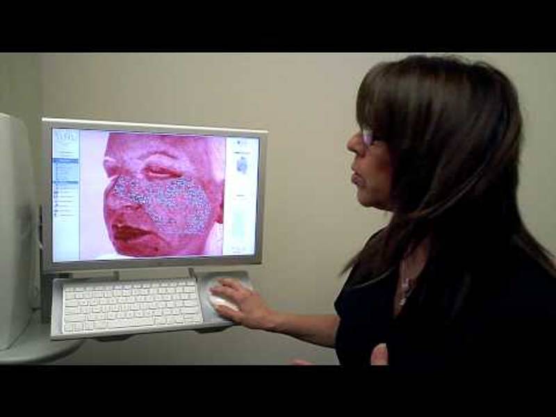 Dr. Jacono – Laser Skin Resurfacing