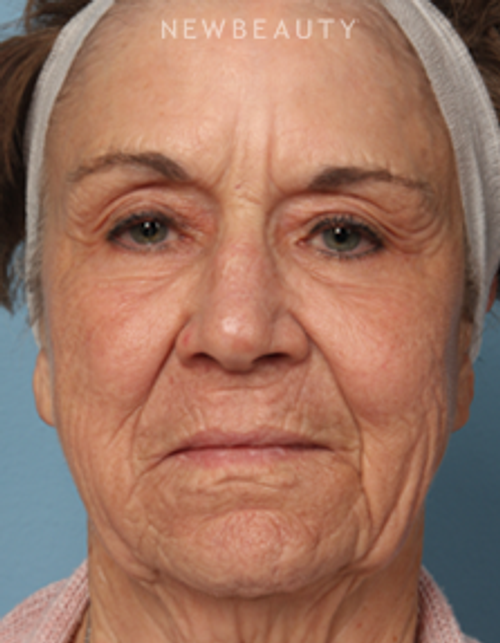 Dr. Kathleen Behr - Injectables & Fillers - After
