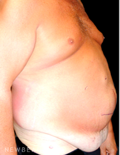 Dr Mokhtar Asaadi Liposuction, Male Plastic Surgery - Before