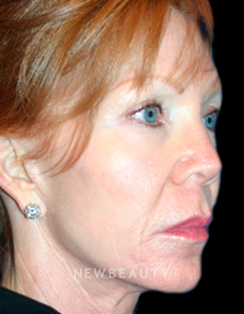 Dr. Kelly Bomer Injectables - Before