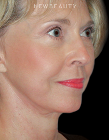 Dr. Henry Mentz - Facelift - After