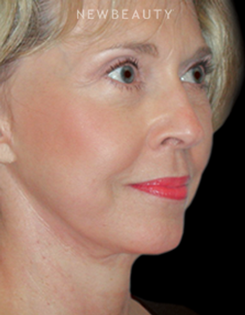Dr. Henry Mentz - Facelift - After