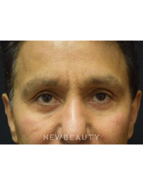 Dr. Jeffrey B. Wise - Lower Blepharoplasty - After