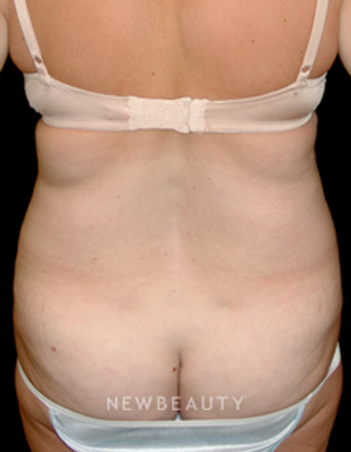 Dr. Mokhtar Asaadi Liposuction Tummy Tuck - Before