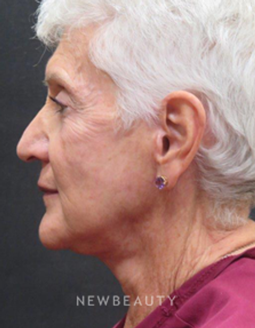 Dr. Elie Levine - Restoring Youthful Contours - After