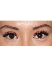 Dr. Lily Lee - Asian Eyelid Revision Surgery - After