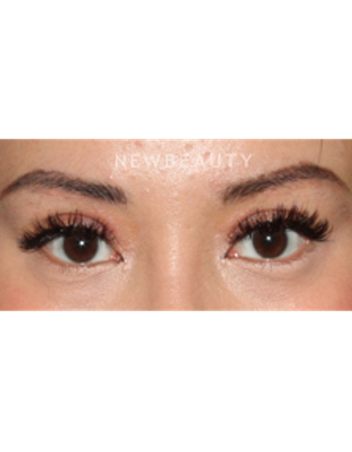 Dr. Lily Lee - Asian Eyelid Revision Surgery - After