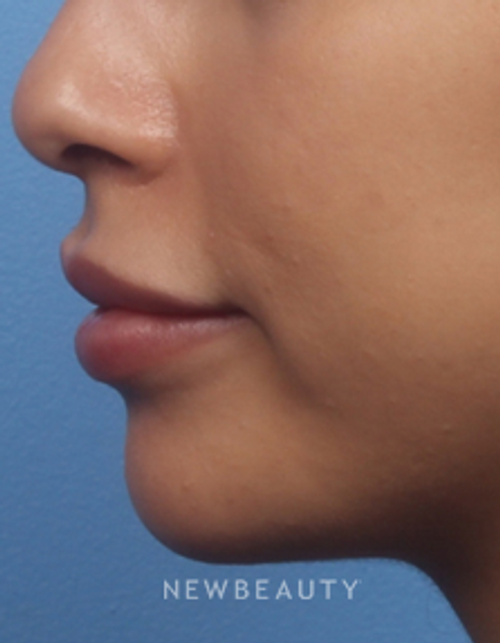 Dr. Kelly Bomer - Chin Augmentation - After