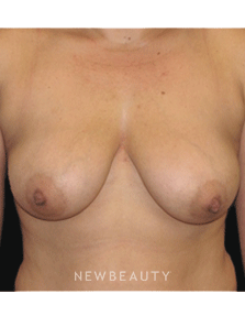Dr. Sean Simon Breast Augmentation, Breast Lift - Before