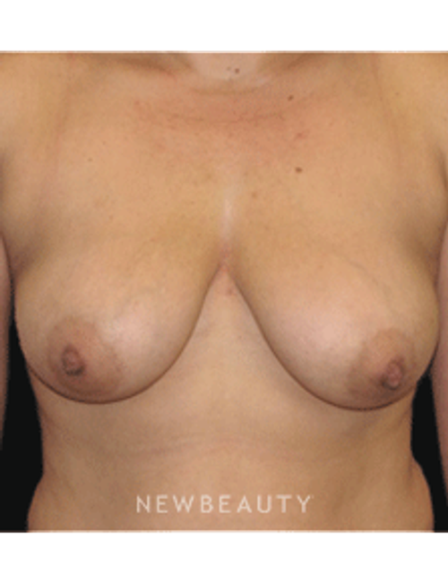 Dr. Sean Simon Breast Augmentation, Breast Lift - Before