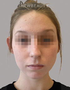 Dr. Anna Chacon - Acne - 34285017 - After