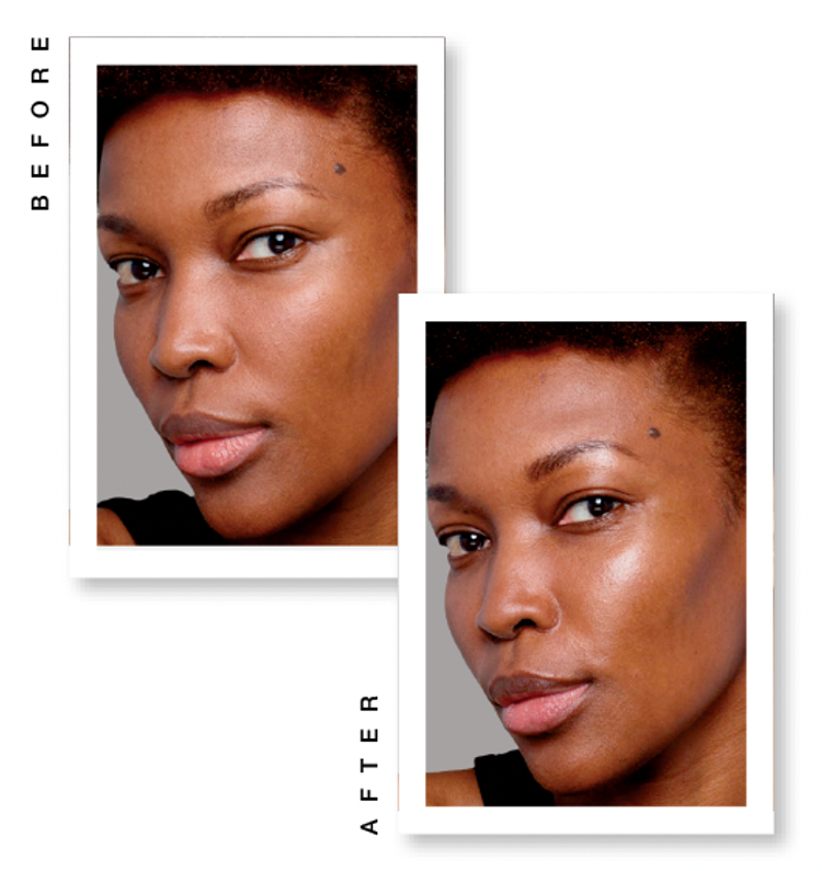 SKINVIVE by Juvéderm SKINVIVE by Juvéderm