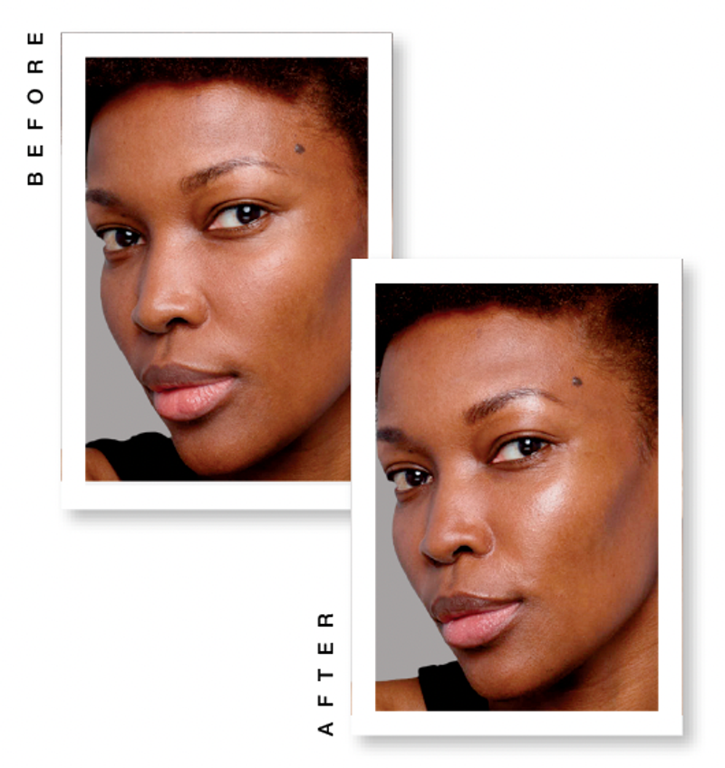 SKINVIVE by Juvéderm