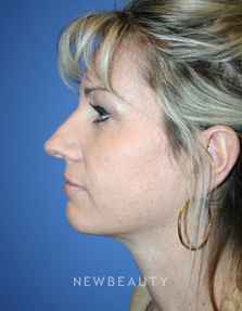 Dr. Kelly Bomer-Rhinoplasty - Before