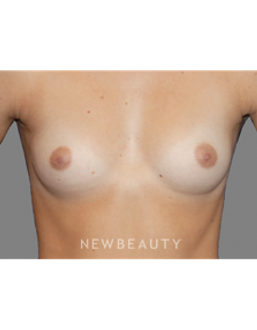 Dr. Bradley Bengtson - Breast Augmentation - Before