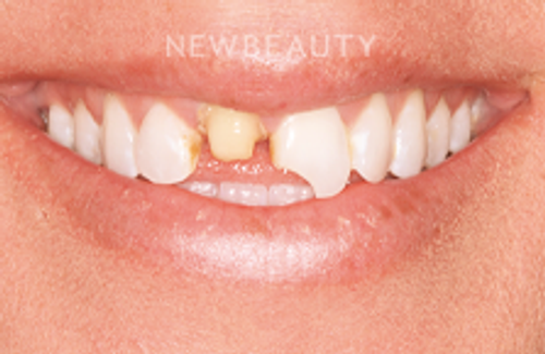Dr. Joe Kravitz - Veneers - 44265252 - Before