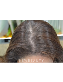 Dr. Julie Russak - Hair Loss Treatment - After