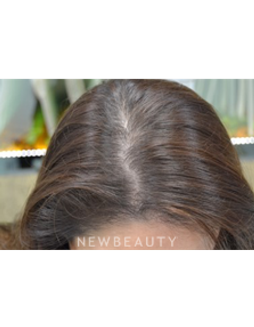 Dr. Julie Russak - Hair Loss Treatment - After
