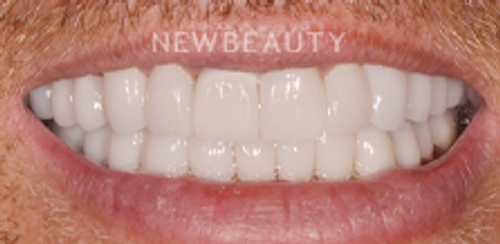 Dr. Salvator La Mastra - Smile Makeover -46106734 - After
