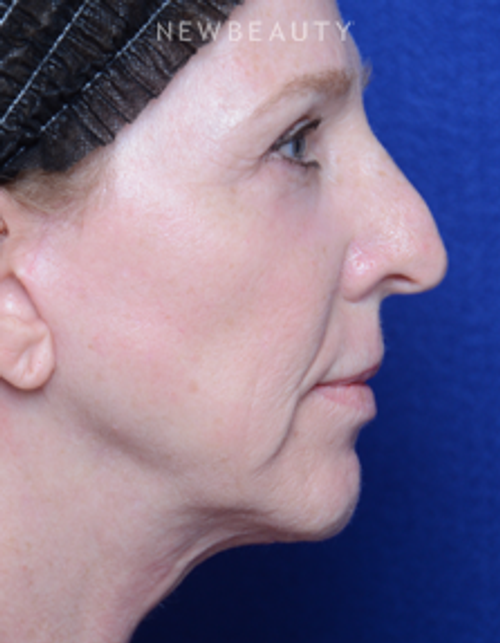 Dr. Alan Durkin - Facelift - After