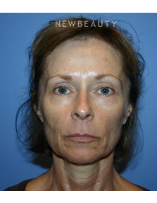 Dr. Kelly Bomer- Facelfit - Before
