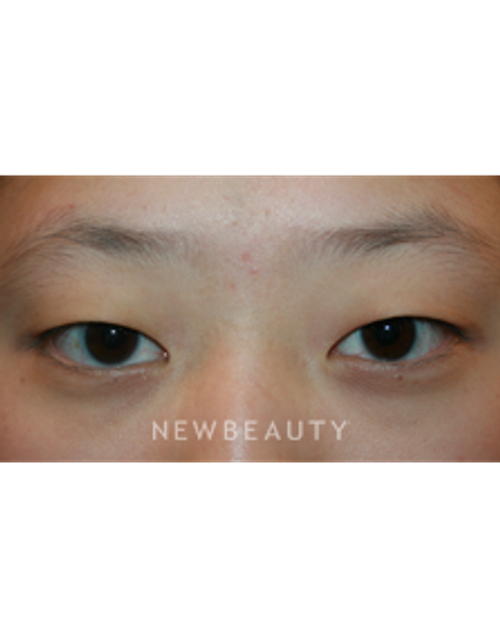 Dr. John Kang - Upper Blepharoplasty - Before