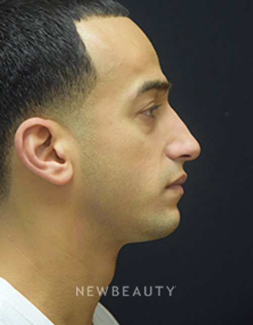 Dr. Jeffrey B. Wise - Rhinoplasty - Before