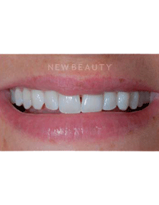 Dr. Guy Lewis Veneers - Before